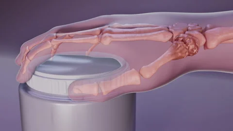 Osteoarthritis of the Thumb Stock Footage 315156739