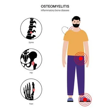 Osteomyelitis in adults Illustrazione stock