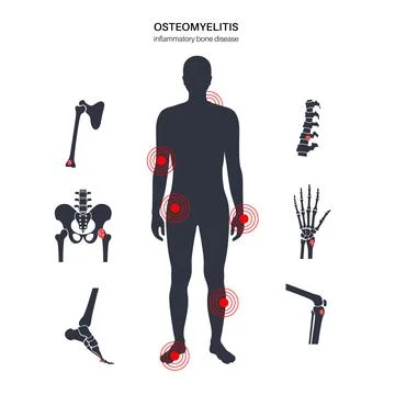 Osteomyelitis in adults Illustrazione stock