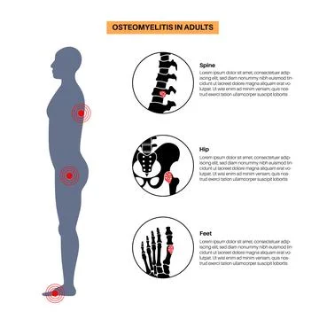 Osteomyelitis in adults Illustrazione stock