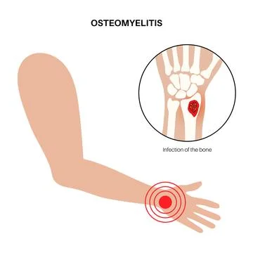 Osteomyelitis of arm Stock Illustration
