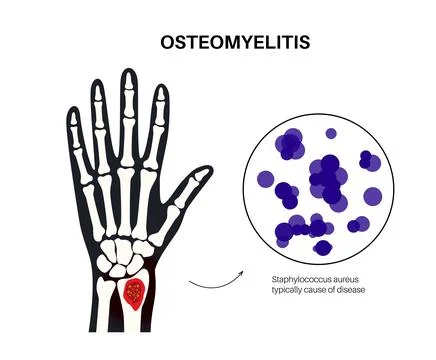Osteomyelitis of arm Illustrazione stock
