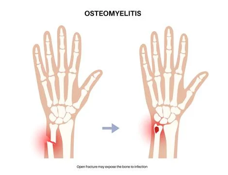 Osteomyelitis of arm Illustrazione stock