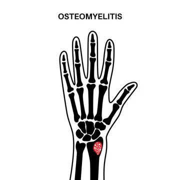 Osteomyelitis of arm Illustrazione stock