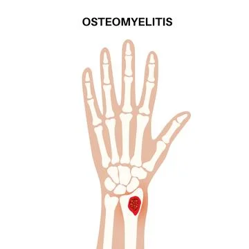 Osteomyelitis of arm Illustrazione stock