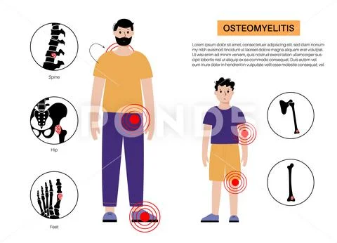 Osteomyelitis children and adults: Royalty Free #251666486