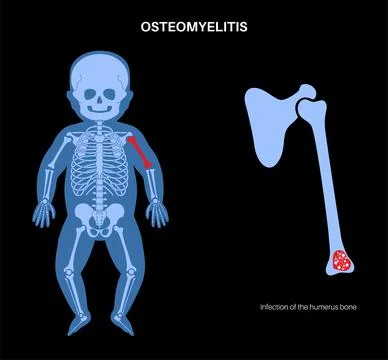 Osteomyelitis in children Illustrazione stock