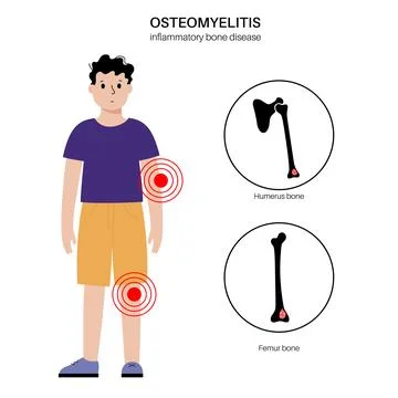 Osteomyelitis in children Stock Illustration
