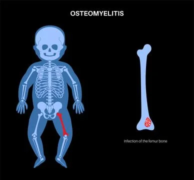 Osteomyelitis in children Illustrazione stock