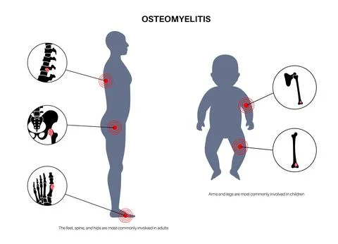 Osteomyelitis disease poster Stock Illustration