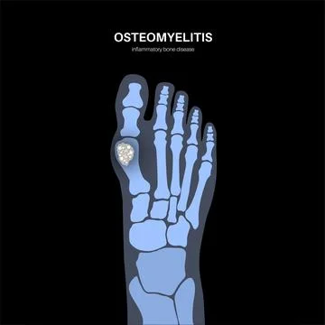 Osteomyelitis of feet Illustrazione stock