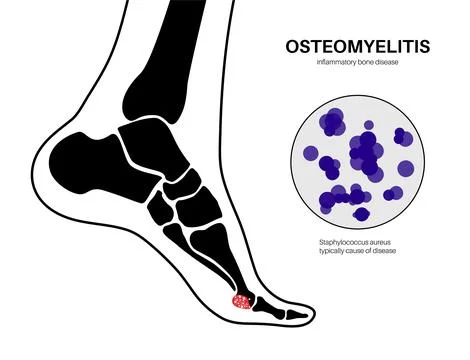 Osteomyelitis of feet Illustrazione stock
