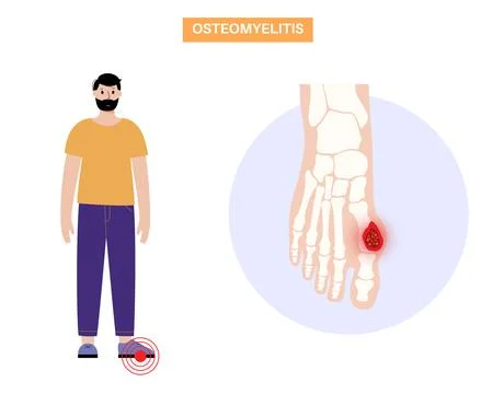 Osteomyelitis of feet Illustrazione stock