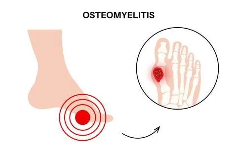 Osteomyelitis of feet Illustrazione stock