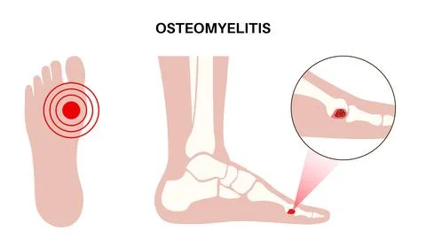 Osteomyelitis of feet Stock Illustration