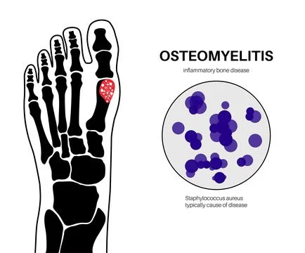 Osteomyelitis of feet Illustrazione stock