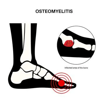 Osteomyelitis of feet Illustrazione stock