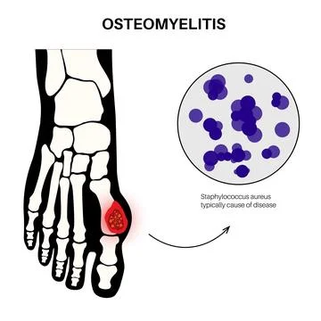 Osteomyelitis of feet Stock Illustration