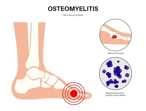 Osteomyelitis of feet Stock Illustration
