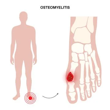 Osteomyelitis of feet Illustrazione stock