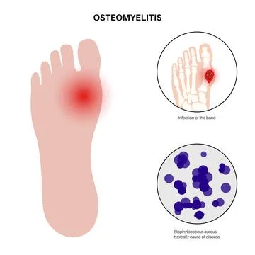 Osteomyelitis of feet Illustrazione stock