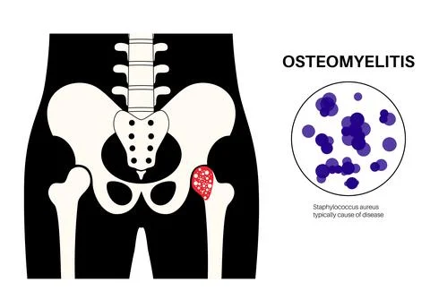 Osteomyelitis of hip Illustrazione stock