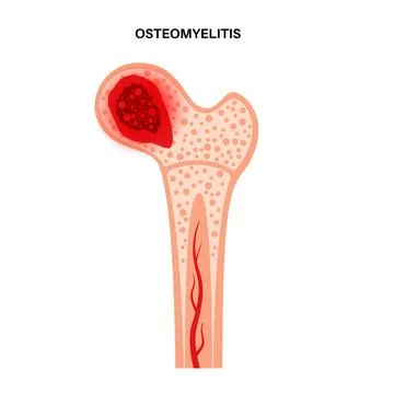 Osteomyelitis of hip Illustrazione stock
