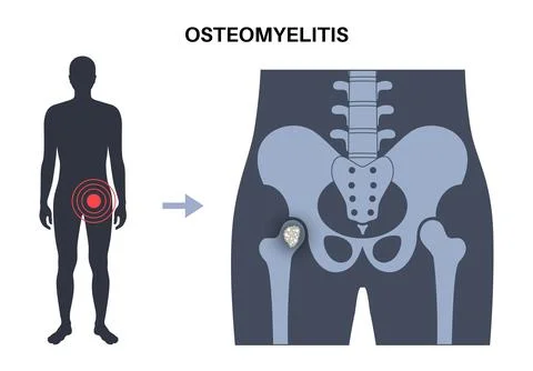 Osteomyelitis of hip Stock Illustration
