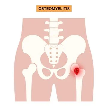 Osteomyelitis of hip Illustrazione stock