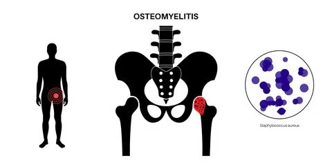 Osteomyelitis of hip Stock Illustration