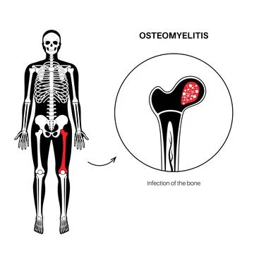 Osteomyelitis of hip Illustrazione stock