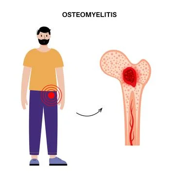Osteomyelitis of hip Illustrazione stock