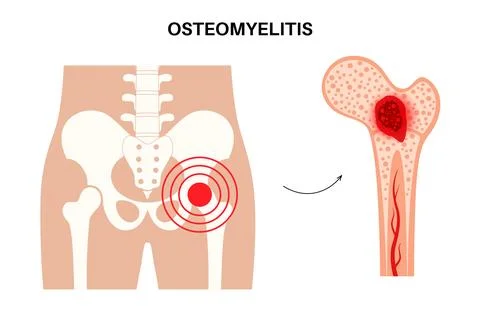 Osteomyelitis of hip Stock Illustration