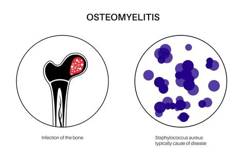 Osteomyelitis of hip Illustrazione stock