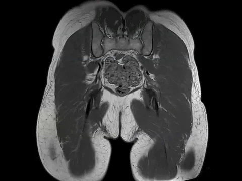 Osteonecrotic hips, MRI scan Stock Footage 105268227