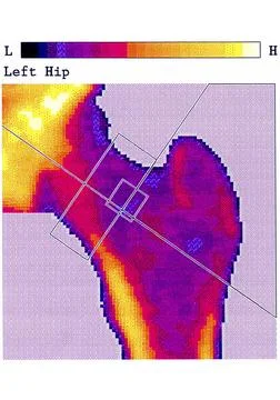  Osteopenia Bone mineral density test (femoral neck). This methods measure... 库存照片