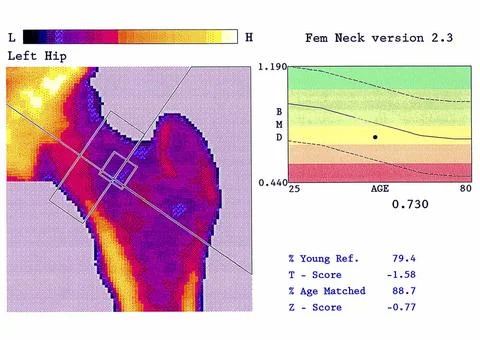  Osteopenia Bone mineral density test (femoral neck). This methods measure... 库存照片