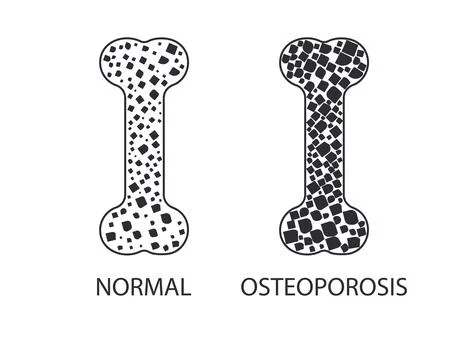Osteoporosis, bone, disease icon. Vector illustration. Illustrazione stock