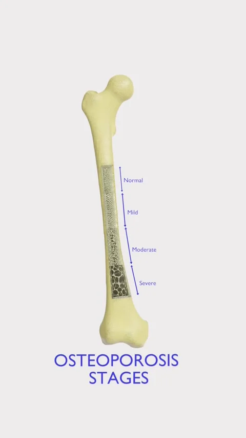 Osteoporosis is a bone disorder characterized by reduced bone density and Stock Footage 343023819