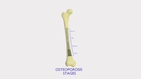 Osteoporosis is a bone disorder characterized by reduced bone density and Stock Footage 343023929