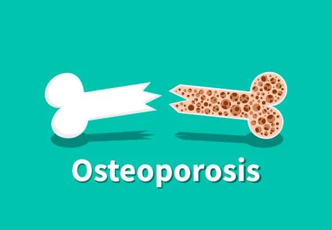 Osteoporosis, Bone structure in vector art design Stock Illustration