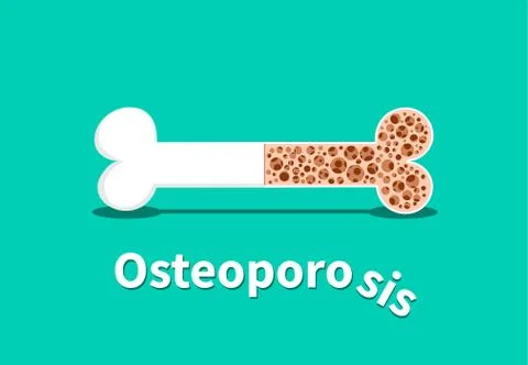 Osteoporosis, Bone structure in vector design Stock Illustration