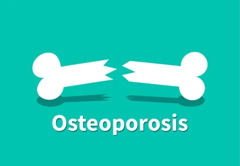 Osteoporosis, Broken bone in vector design Stock Illustration