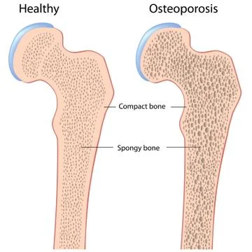 Osteoporosis of hip bone (femur) Stock Illustration