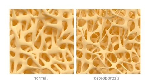 Osteoporosis Stock Illustration