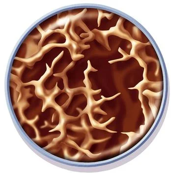  Osteoporosis, illustration Stucture of the bone affected by osteoporosis ... Stock Photos
