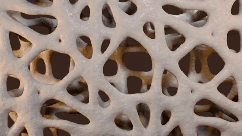 Osteoporosis With Loss of Bone Density 스톡 동영상 309620857