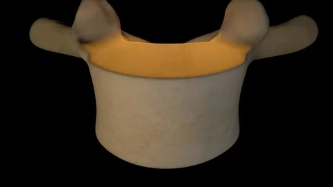 Osteoporosis Of The Vertebrae 스톡 동영상 122814499