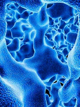 Osteoporotic bone, artwork Illustrazione stock