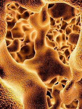 Osteoporotic bone, artwork Illustrazione stock